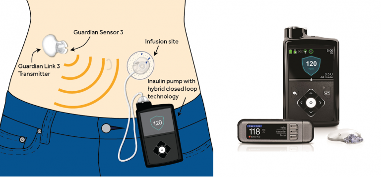 Искусственная поджелудочная железа Medtronic MiniMed 670G поступила в продажу